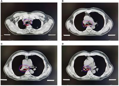 ER predicts poor prognosis in male lung squamous cell cancer of stage IIIA-N2 disease after sequential adjuvant chemoradiotherapy